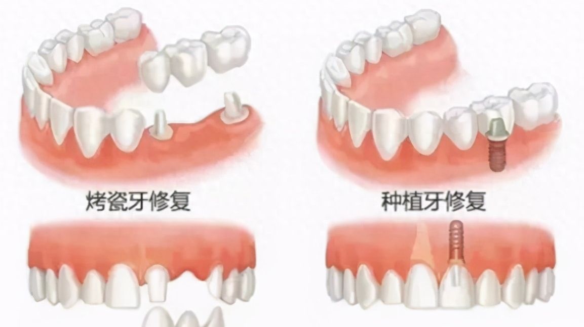 錦江貝臣口腔門診部的種植牙服務(wù)測評(píng)：價(jià)格實(shí)不實(shí)在，療效如何？