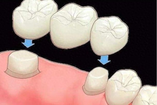 北京牙齒矯正醫(yī)院推薦及費(fèi)用參考