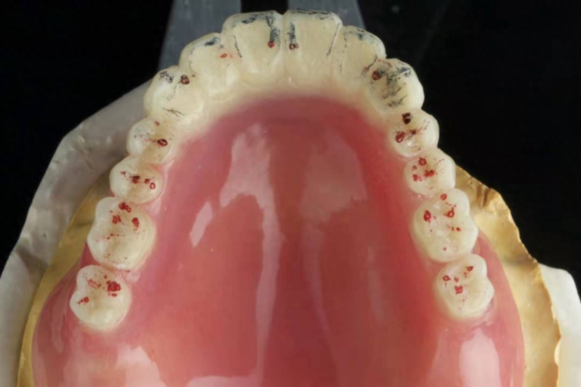 全口假牙多少錢？專家解讀價(jià)格差異，推薦性價(jià)比高的種植方案